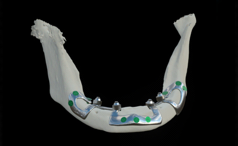 IMPLANT HYBRYDOWY